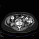 Porcelain gallbladder, calcification of gallbladder, cholecystolithiasis, gallstones: CT - Computed tomography